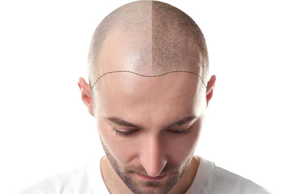 Hair Transplant: Is It A Cosmetic Surgery?