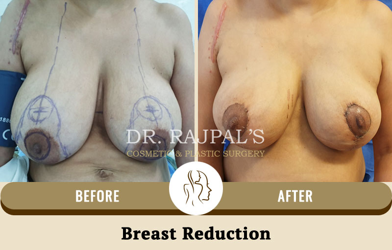 Breast Reduction